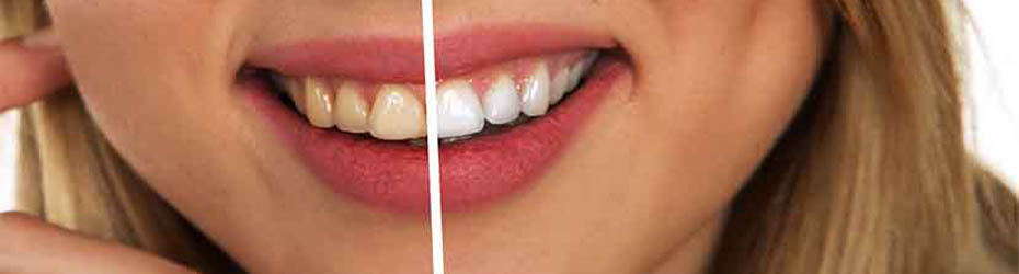 Does Coffee Stain Your Teeth Permanently Darleen Avery